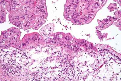 Novel Technique May Improve Success of Ovarian Cancer Treatment, Study Reveals