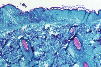 Monkeypox Unlikely to Become Next Pandemic, Says U of G Researcher